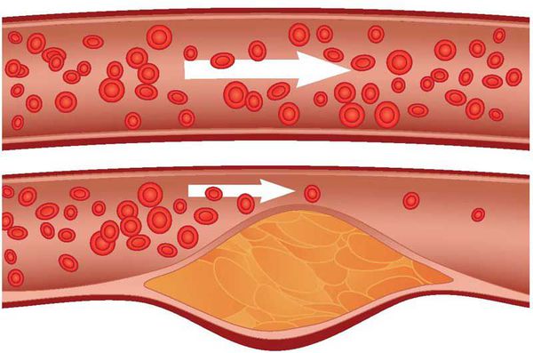 Атеросклероз: что это такое, симптомы, стадии, профилактика и лечение