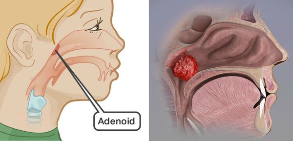 Гипертрофия аденоидов и аденоидит