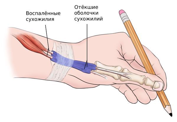 Болезнь де Кервена