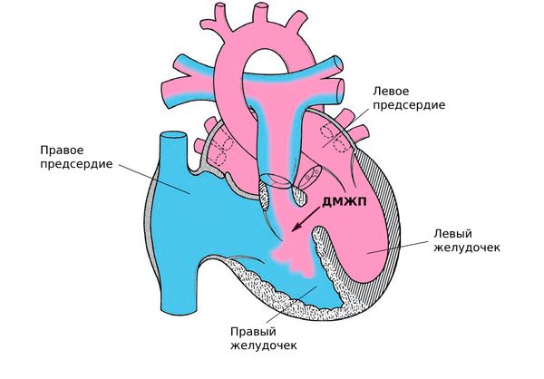 Дефект межжелудочковой перегородки (ДМЖП): причины, симптомы и лечение