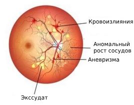 Диабетическая ангиопатия