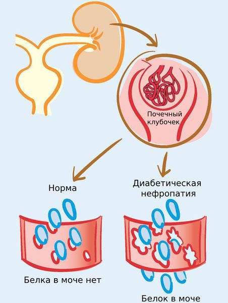 Диабетическая нефропатия: причины, симптомы и лечение