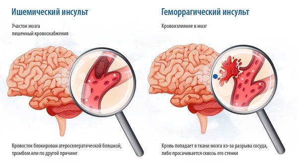 Ишемический и геморрагический инсульт