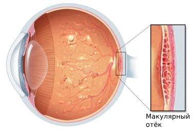 Макулярный отёк