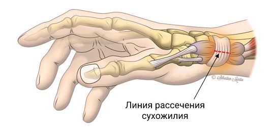 Операция при болезни де Кервена