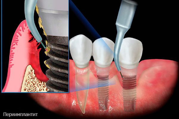 Периимплантит
