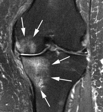 Поражение суставов на МРТ