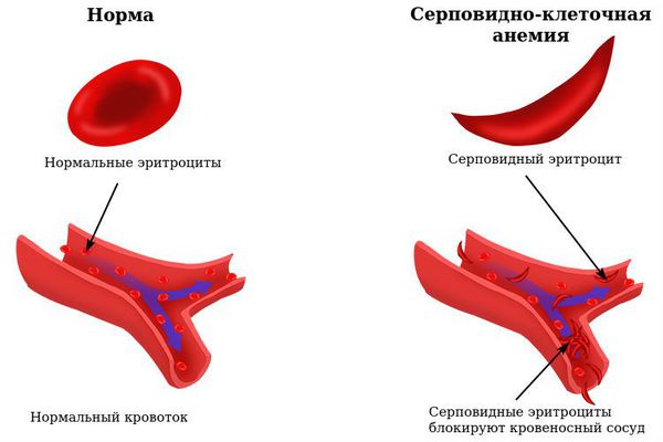 Серповидно-клеточная анемия