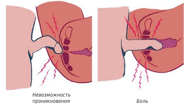 Признаки вагинизма