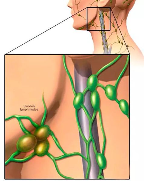 Воспаление подчелюстных лимфоузлов